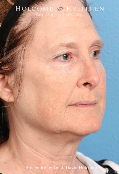 Facelift Before & After Gallery - Patient 953398 - Image 1