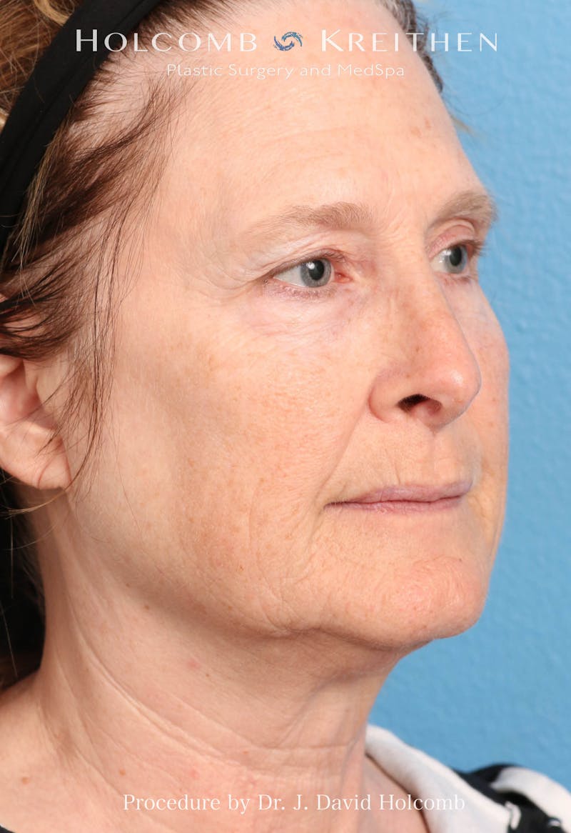 Facelift Before & After Gallery - Patient 953398 - Image 1