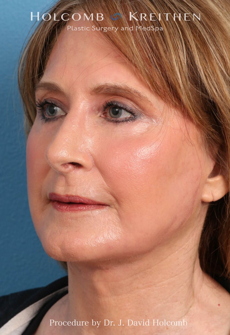 Facelift Before & After Gallery - Patient 953398 - Image 4