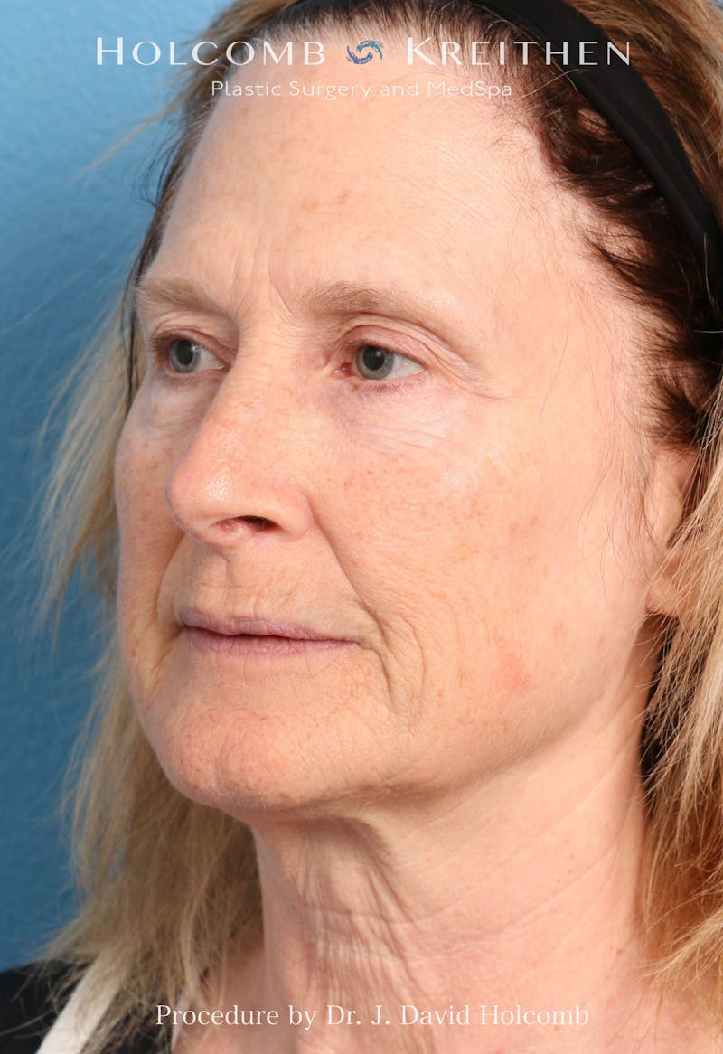 Facelift Before & After Gallery - Patient 953398 - Image 3