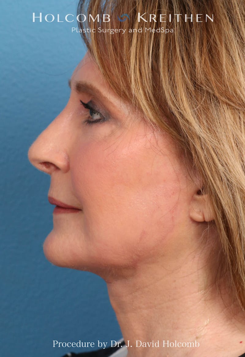Facelift Before & After Gallery - Patient 953398 - Image 6
