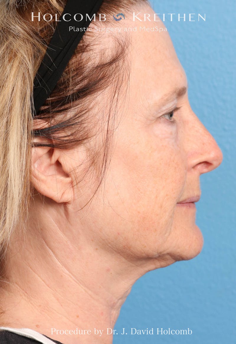 Facelift Before & After Gallery - Patient 953398 - Image 7