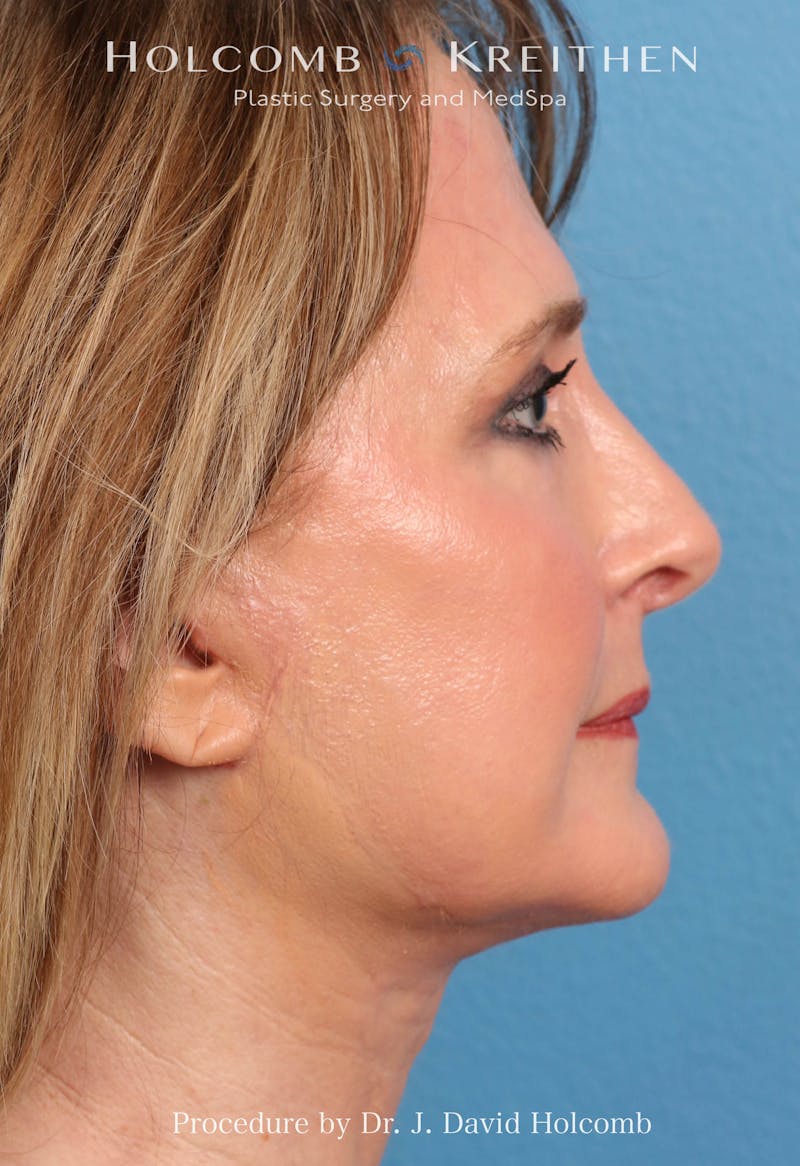 Facelift Before & After Gallery - Patient 953398 - Image 8