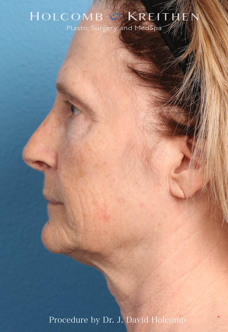 Facelift Before & After Gallery - Patient 953398 - Image 5