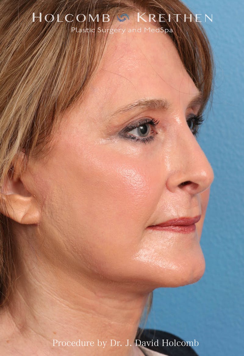 Facelift Before & After Gallery - Patient 953398 - Image 2