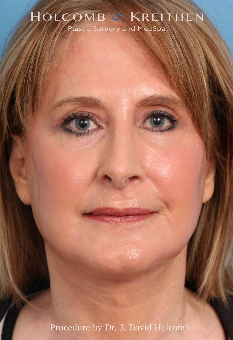 Facelift Before & After Gallery - Patient 953398 - Image 10