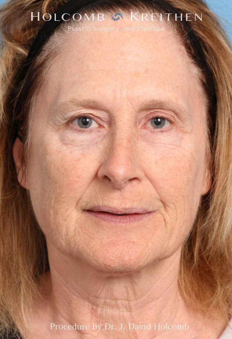 Facelift Before & After Gallery - Patient 953398 - Image 9