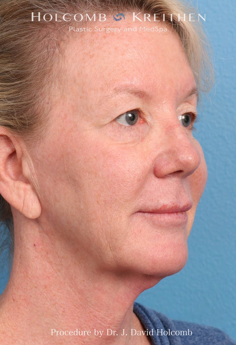 Facelift Before & After Gallery - Patient 374265 - Image 1