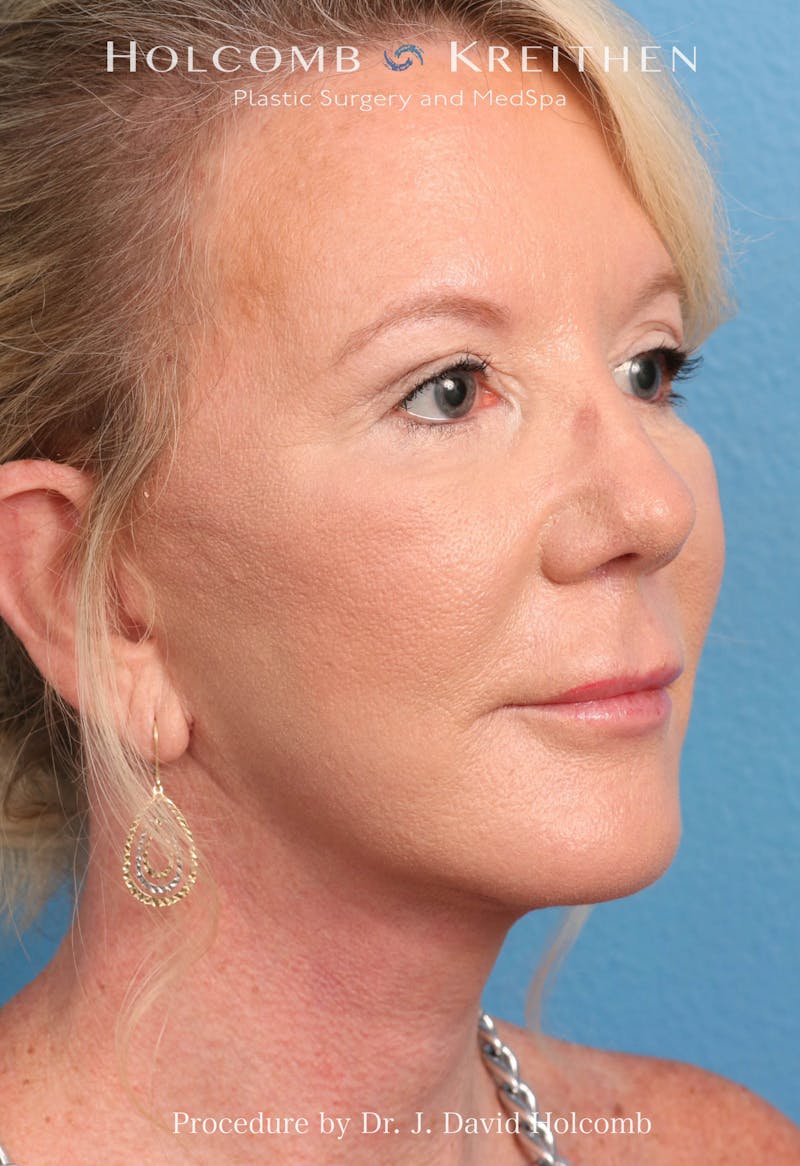 Facelift Before & After Gallery - Patient 374265 - Image 2
