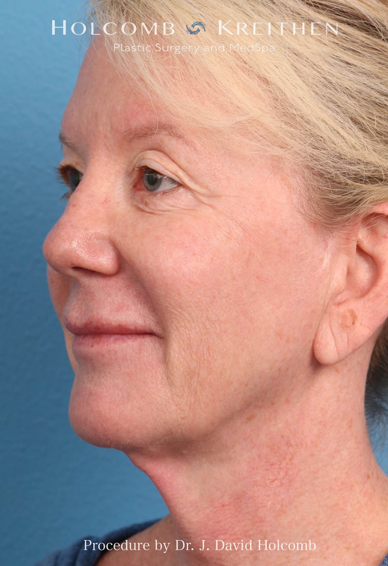 Facelift Before & After Gallery - Patient 374265 - Image 3