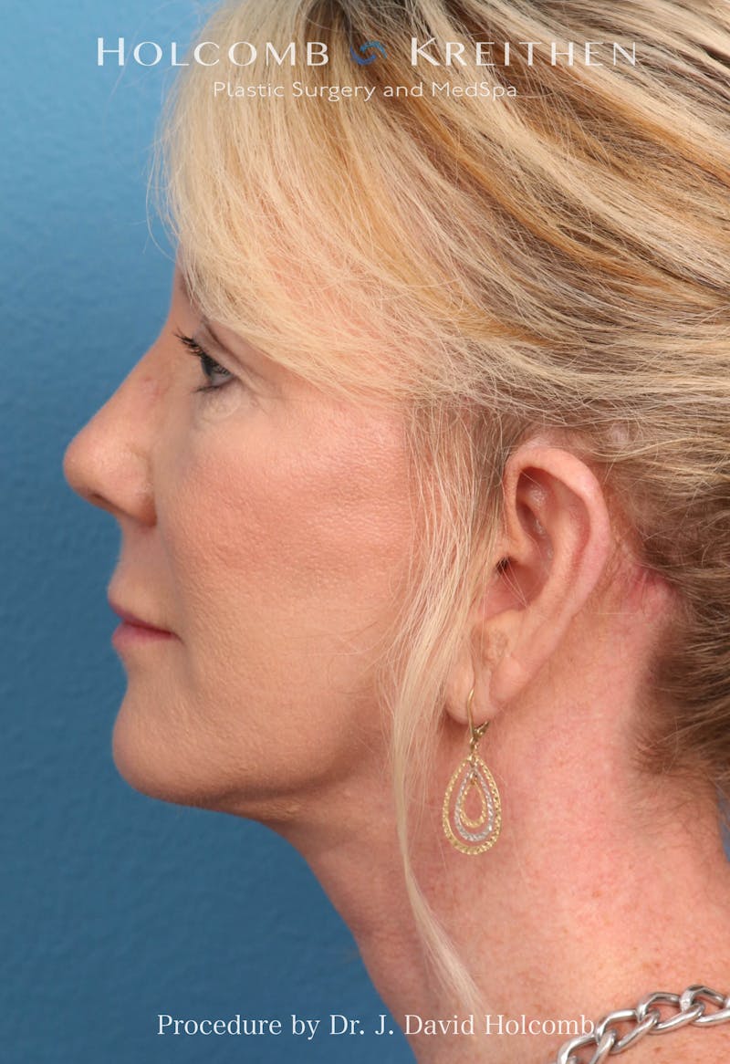 Facelift Before & After Gallery - Patient 374265 - Image 6