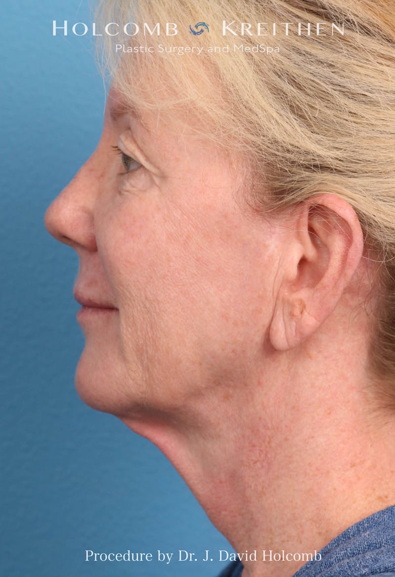 Facelift Before & After Gallery - Patient 374265 - Image 5