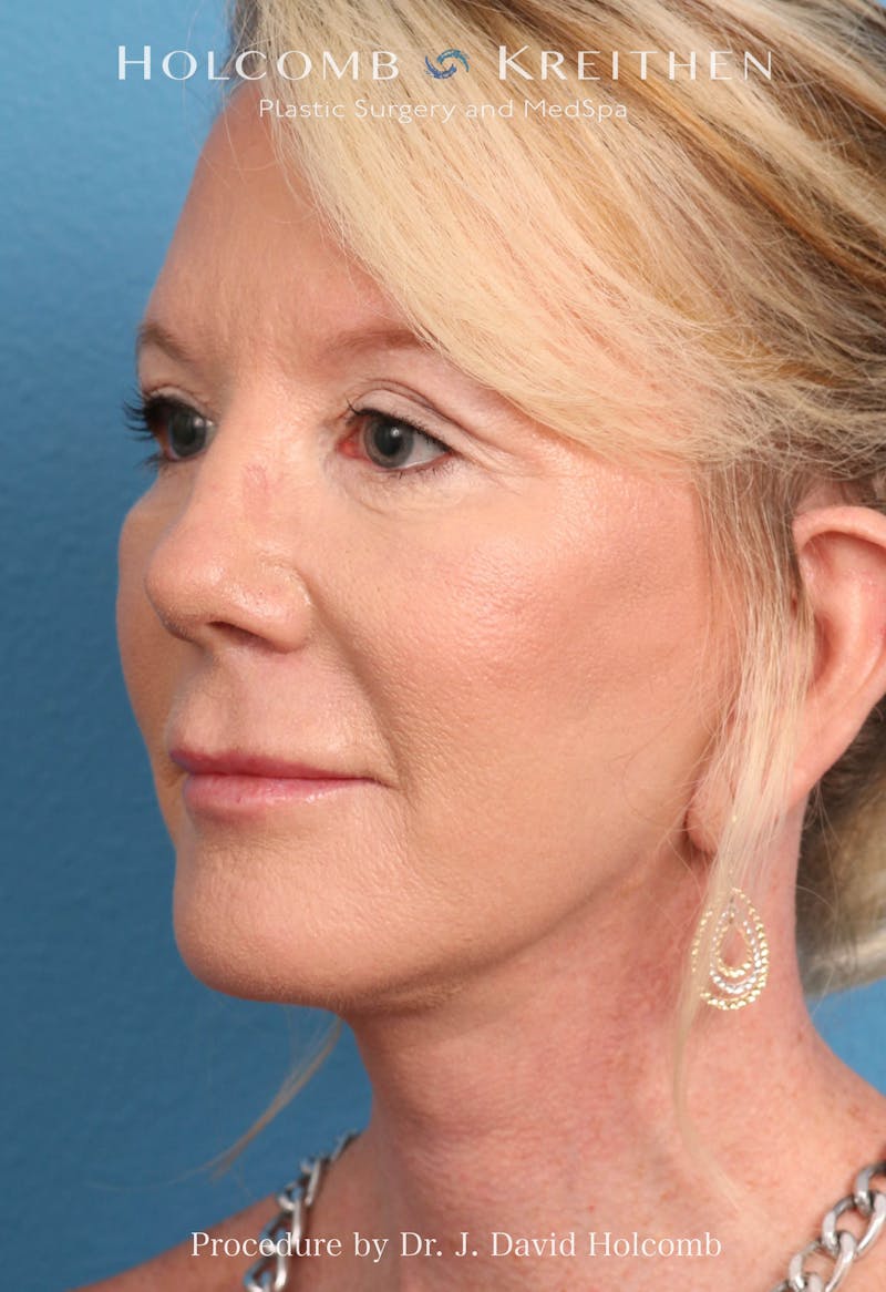 Facelift Before & After Gallery - Patient 374265 - Image 4