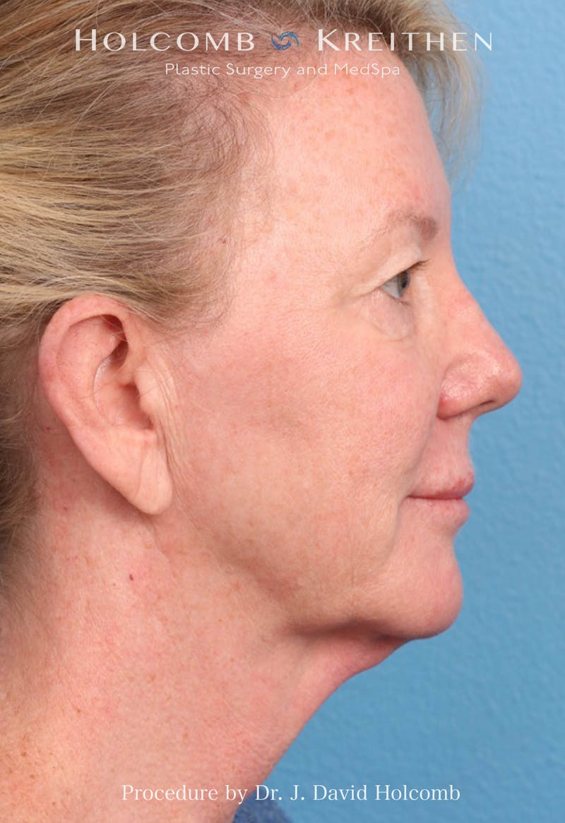 Facelift Before & After Gallery - Patient 374265 - Image 7