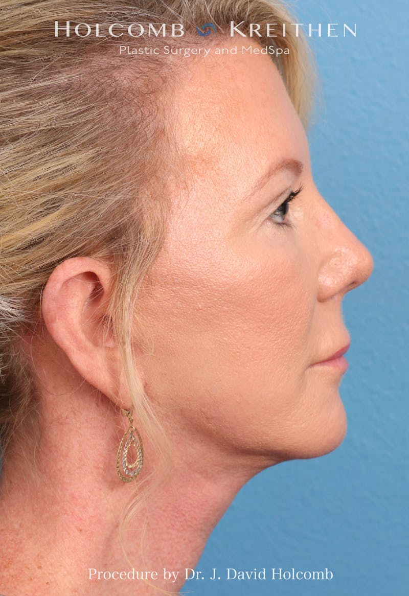 Facelift Before & After Gallery - Patient 374265 - Image 8