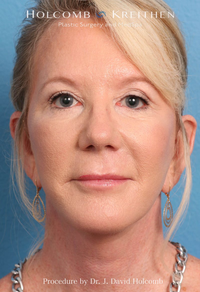 Facelift Before & After Gallery - Patient 374265 - Image 10
