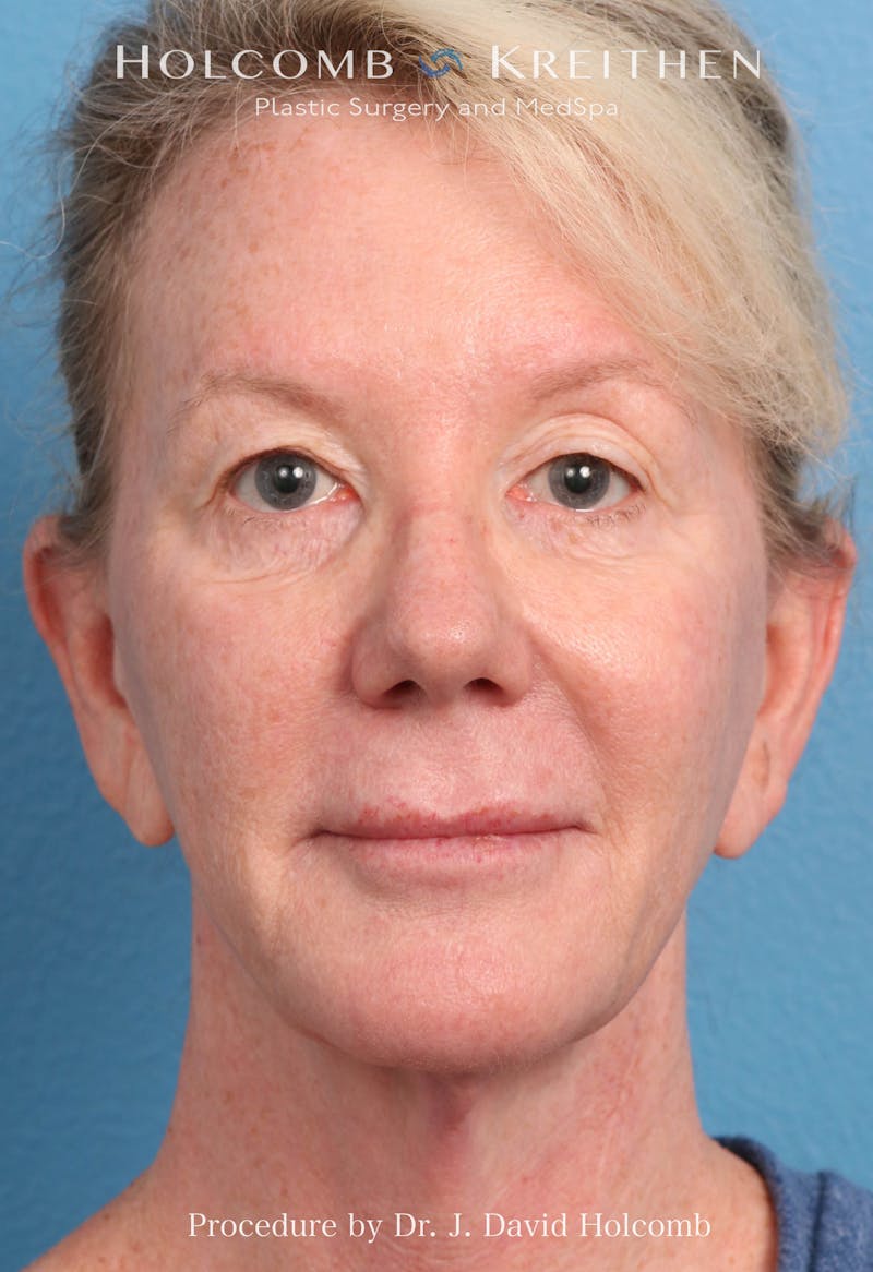 Facelift Before & After Gallery - Patient 374265 - Image 9