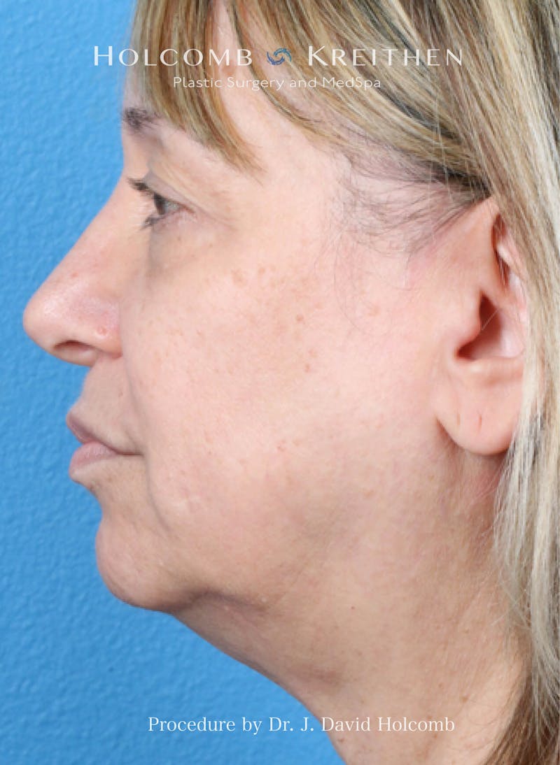 Facelift Before & After Gallery - Patient 779886 - Image 1