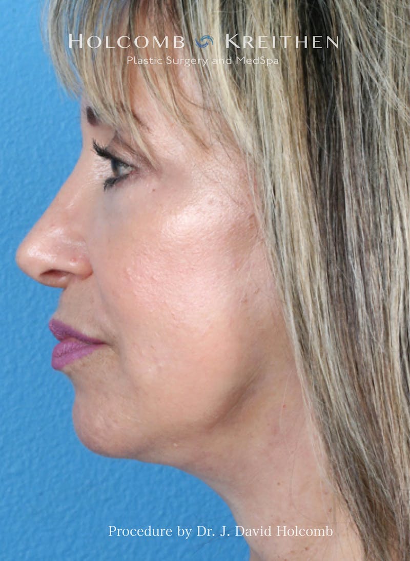 Facelift Before & After Gallery - Patient 779886 - Image 2