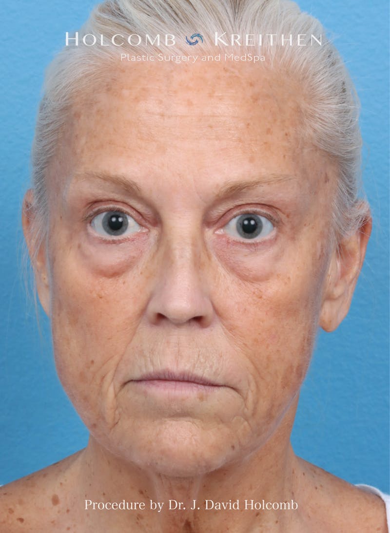 Facelift Before & After Gallery - Patient 354762 - Image 1