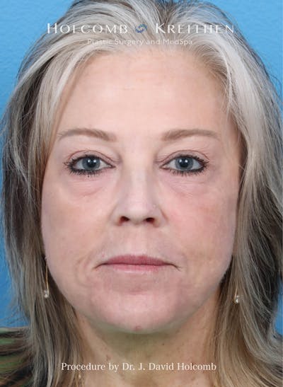 eCO2 Fractional Laser Before & After Gallery - Patient 929346 - Image 2