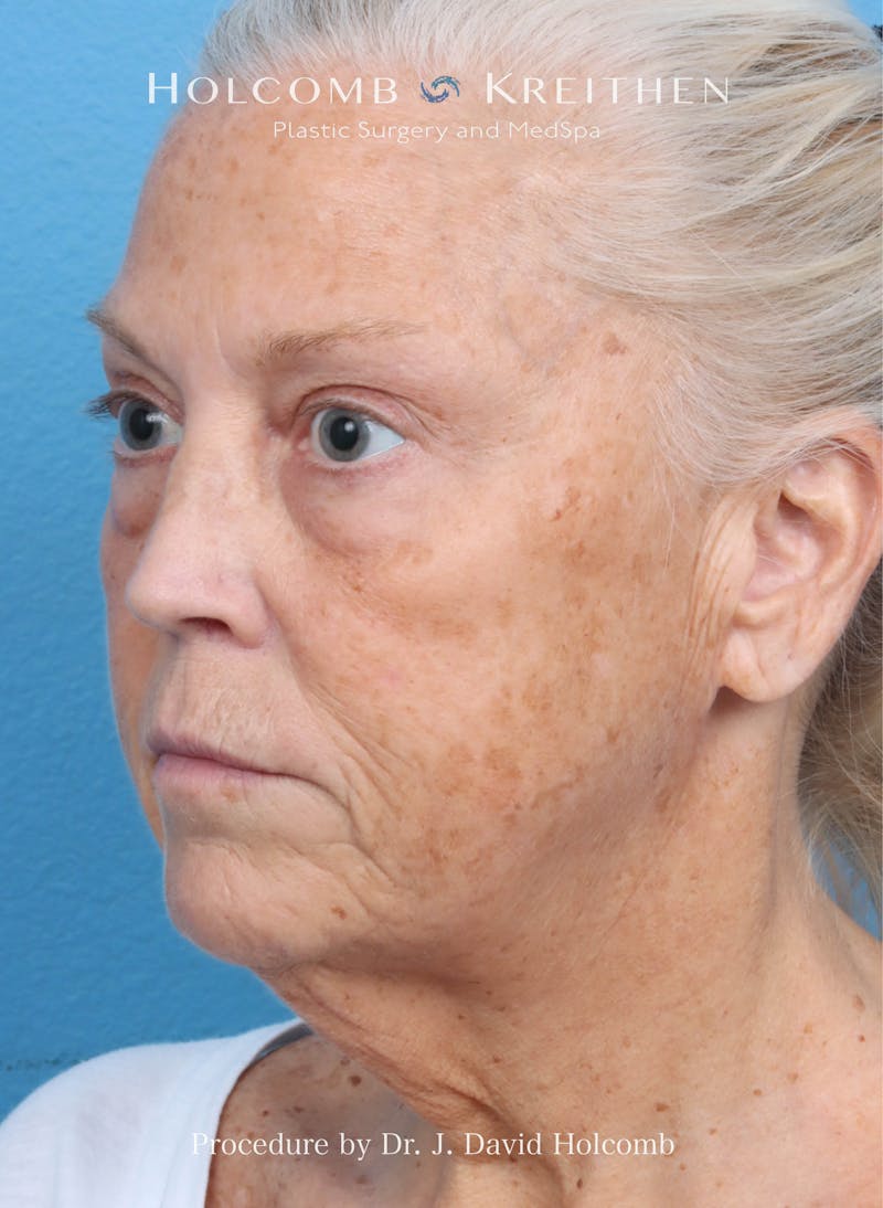 Facelift Before & After Gallery - Patient 354762 - Image 3