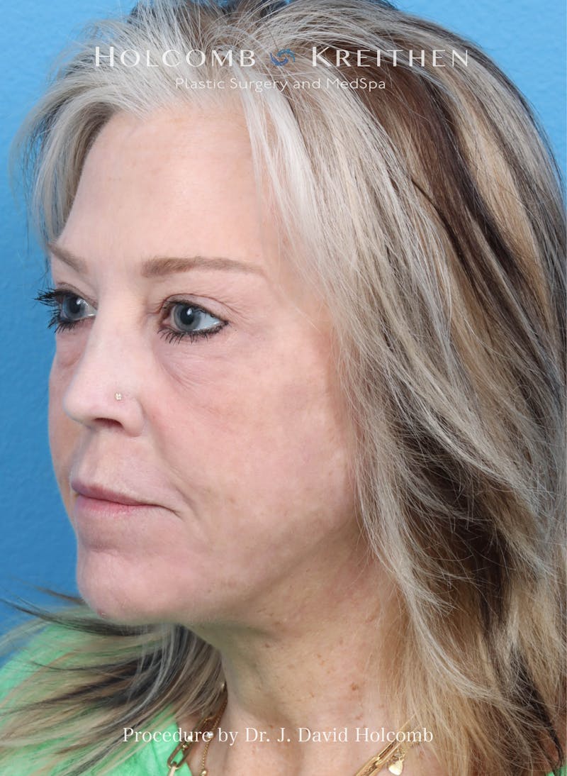 Facelift Before & After Gallery - Patient 354762 - Image 4