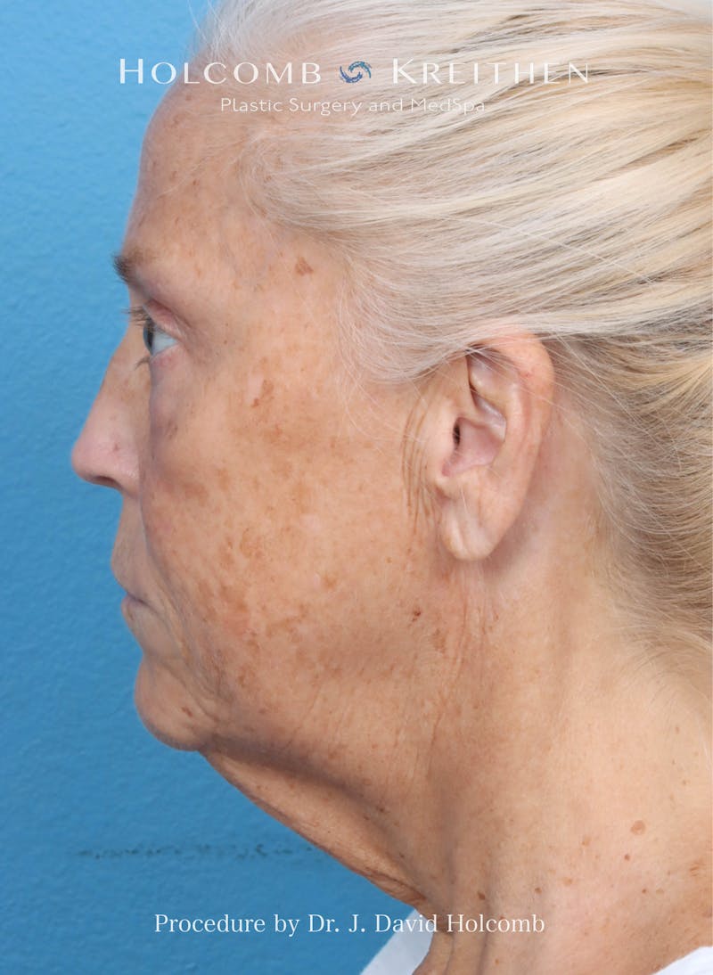 Facelift Before & After Gallery - Patient 354762 - Image 5
