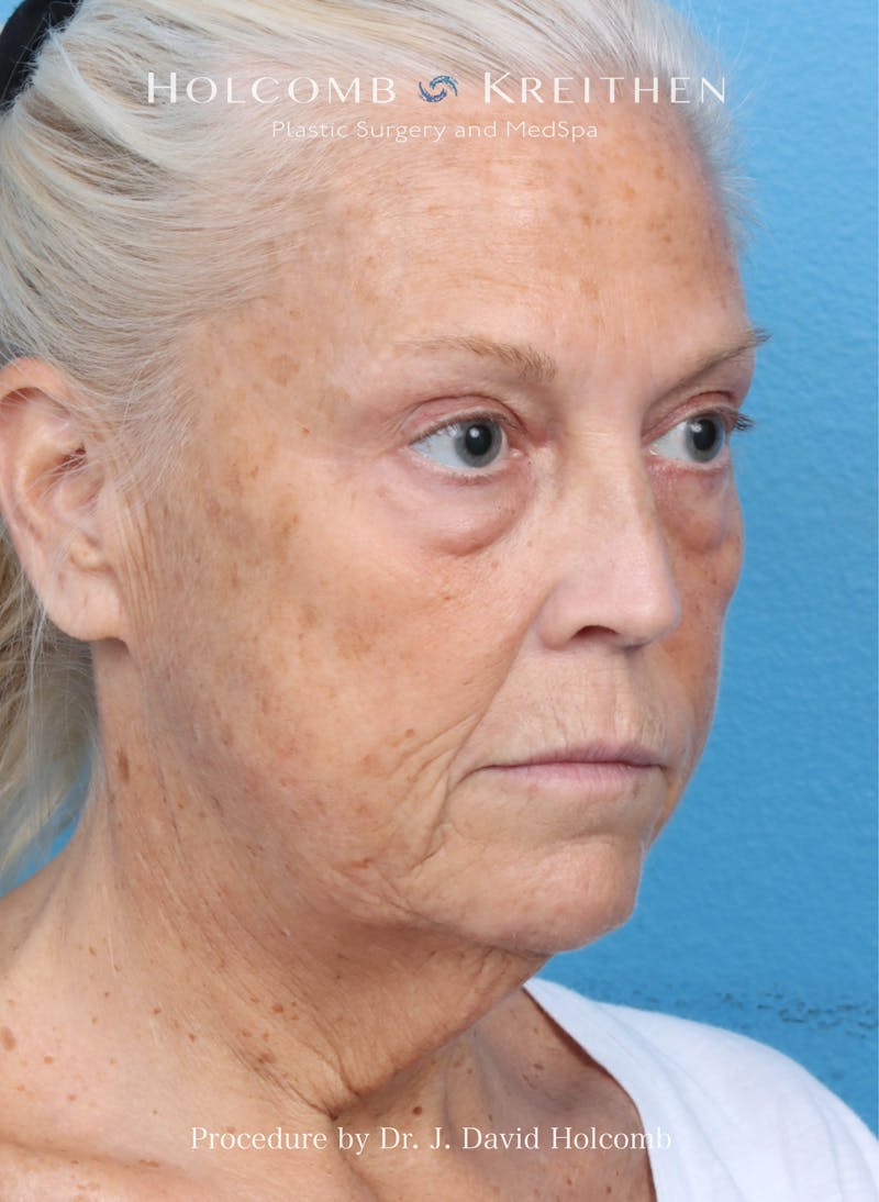 Facelift Before & After Gallery - Patient 354762 - Image 7