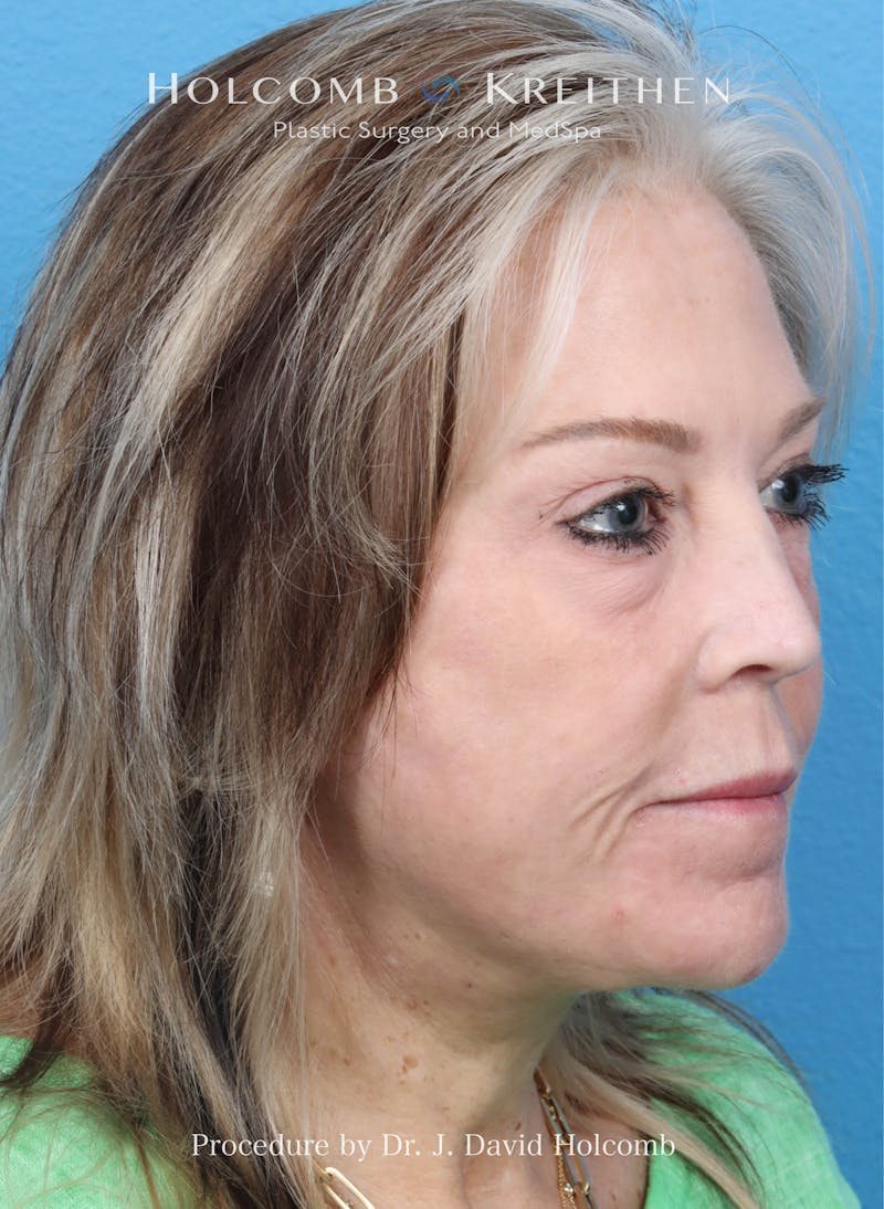Facelift Before & After Gallery - Patient 354762 - Image 8