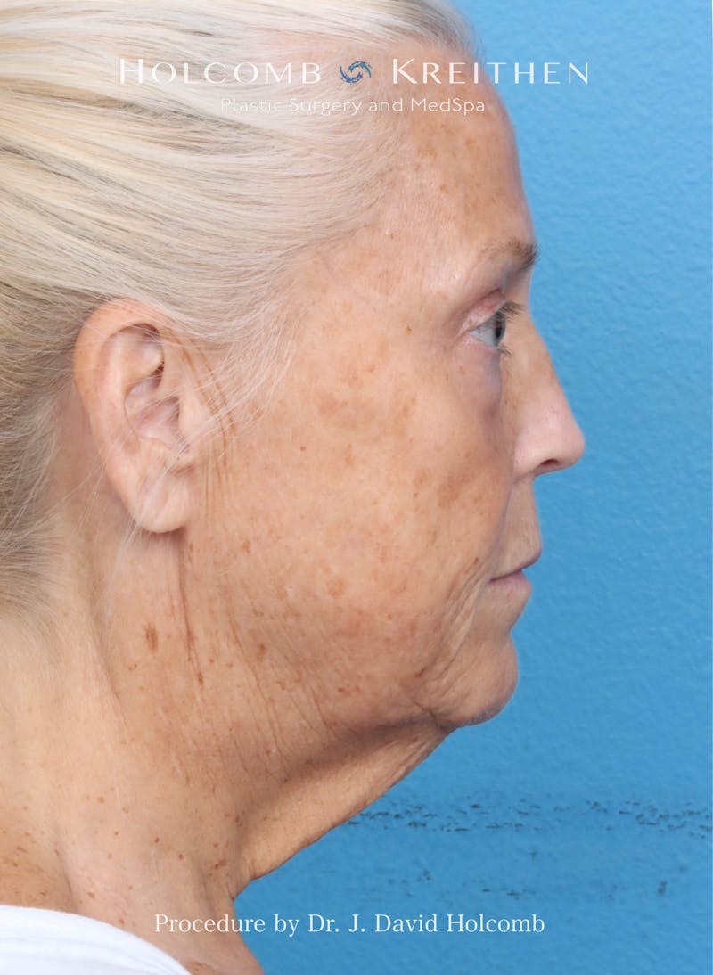 Facelift Before & After Gallery - Patient 354762 - Image 9