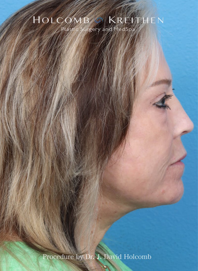Facelift Before & After Gallery - Patient 354762 - Image 10