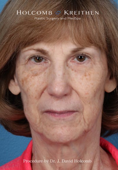 eCO2 Fractional Laser Before & After Gallery - Patient 415001 - Image 1