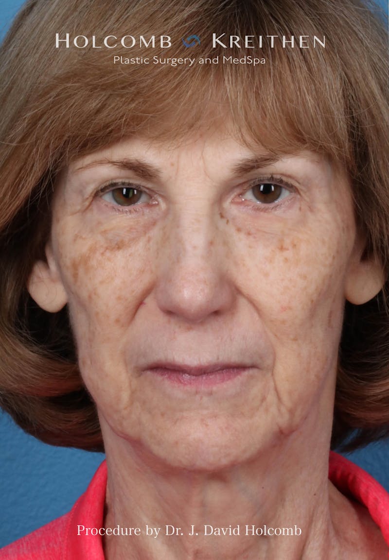 Facelift Before & After Gallery - Patient 239724 - Image 1
