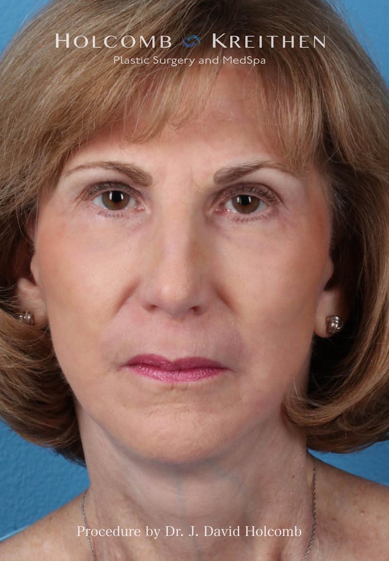 Facelift Before & After Gallery - Patient 239724 - Image 2