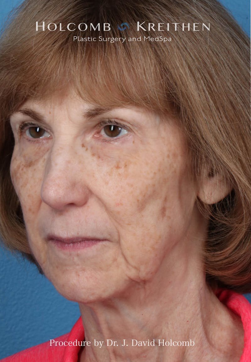 Facelift Before & After Gallery - Patient 239724 - Image 3