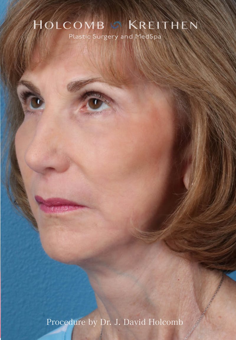 Facelift Before & After Gallery - Patient 239724 - Image 4