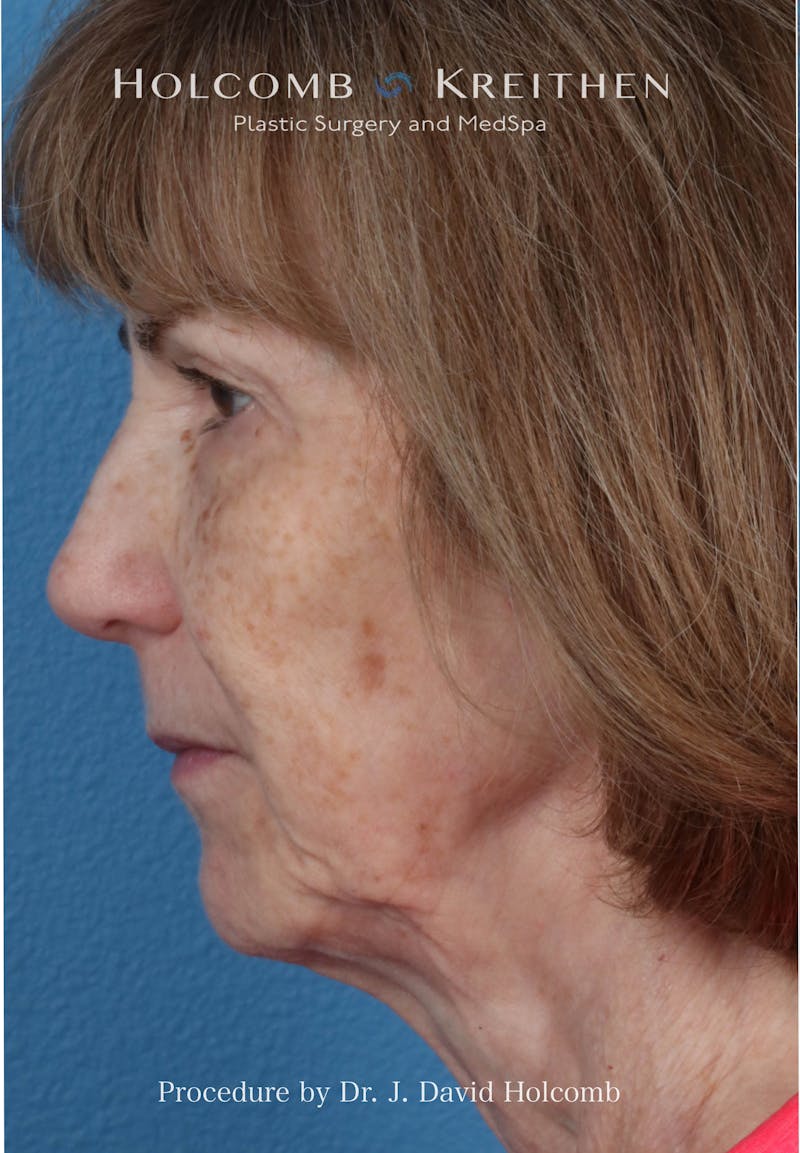 Facelift Before & After Gallery - Patient 239724 - Image 5