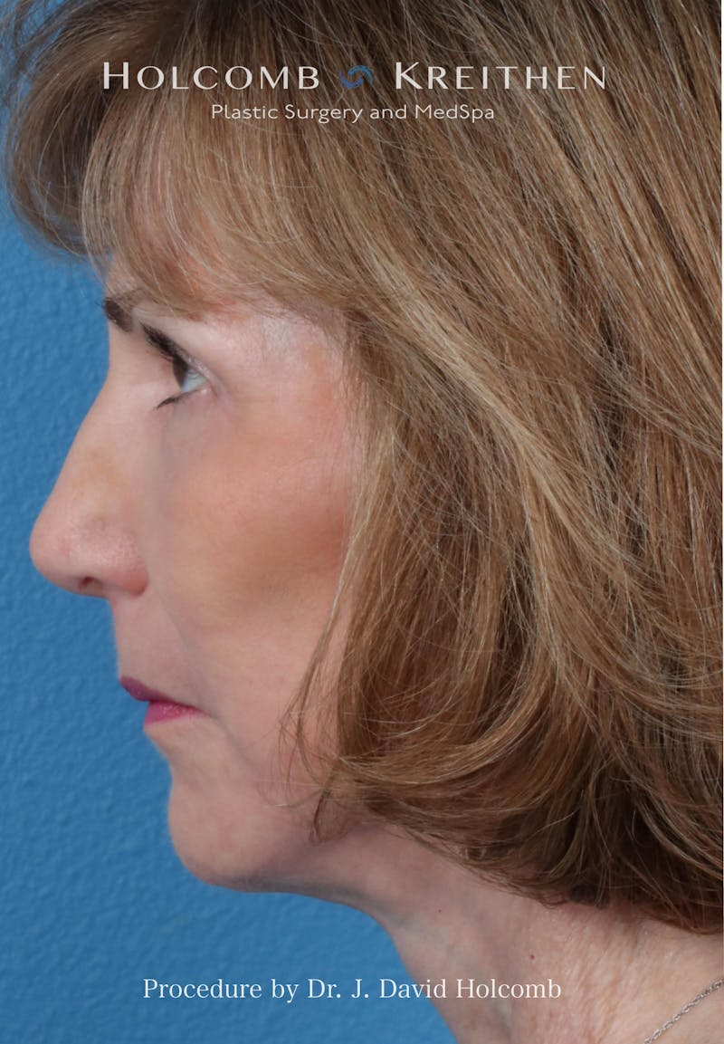Facelift Before & After Gallery - Patient 239724 - Image 6