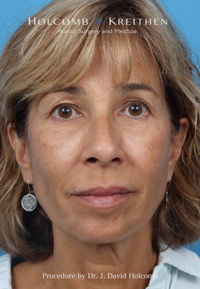 Facelift Before & After Gallery - Patient 153709 - Image 1