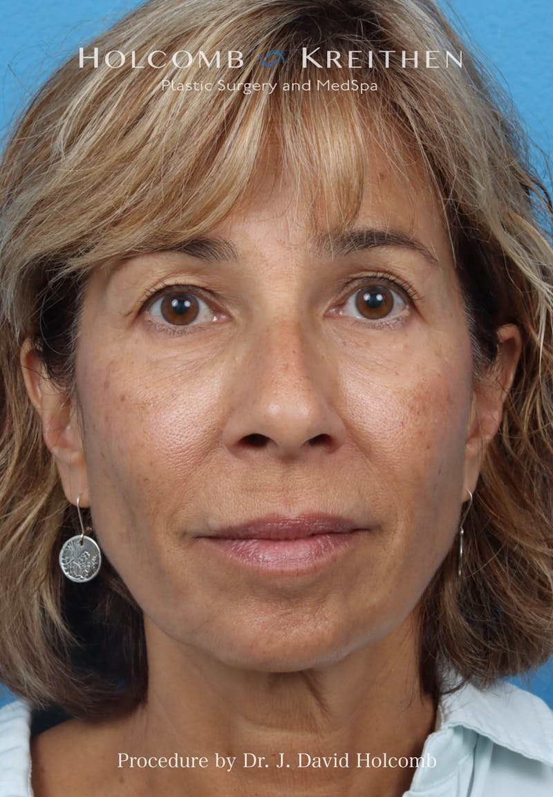 Facelift Before & After Gallery - Patient 153709 - Image 1