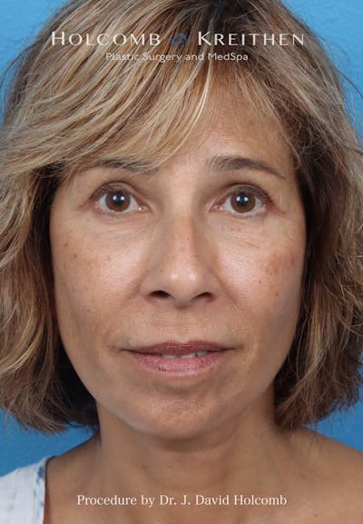 Facelift Before & After Gallery - Patient 153709 - Image 2