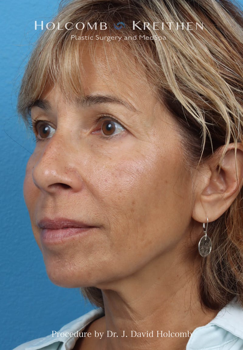 Facelift Before & After Gallery - Patient 153709 - Image 3