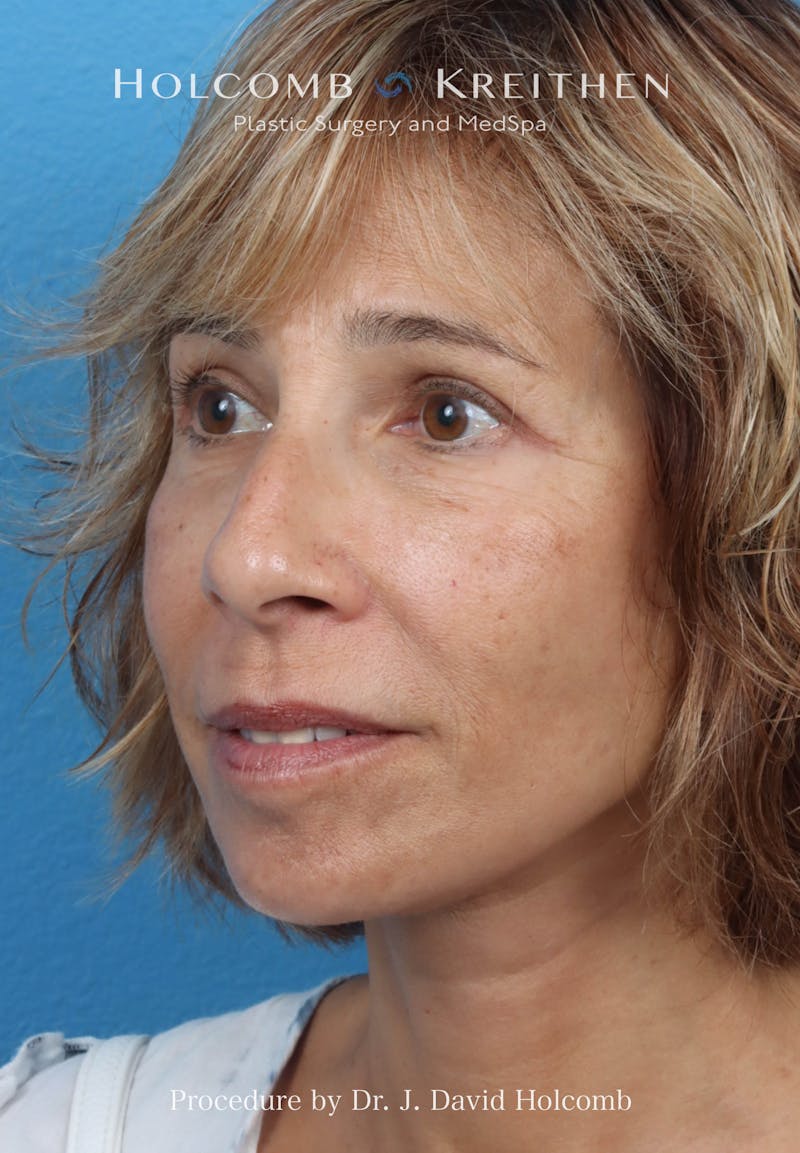 Facelift Before & After Gallery - Patient 153709 - Image 4