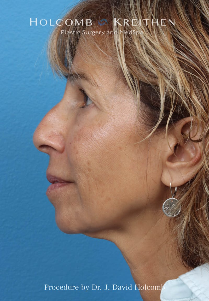 Facelift Before & After Gallery - Patient 153709 - Image 5