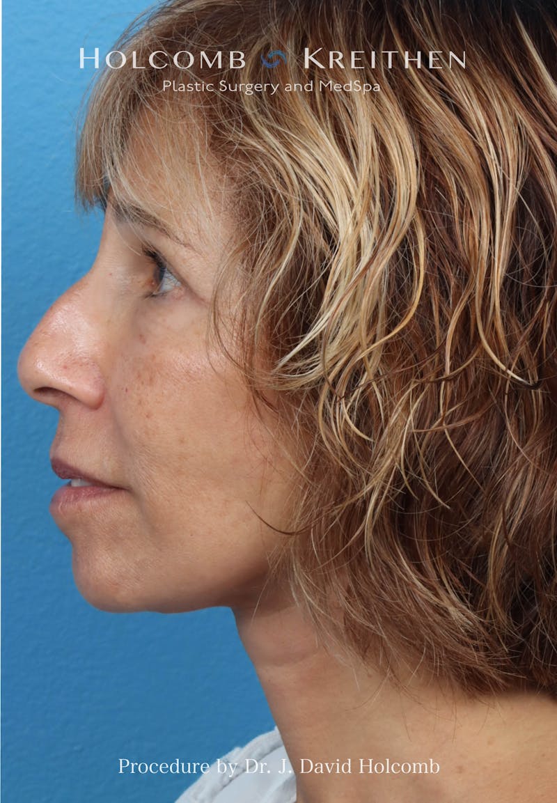Facelift Before & After Gallery - Patient 153709 - Image 6