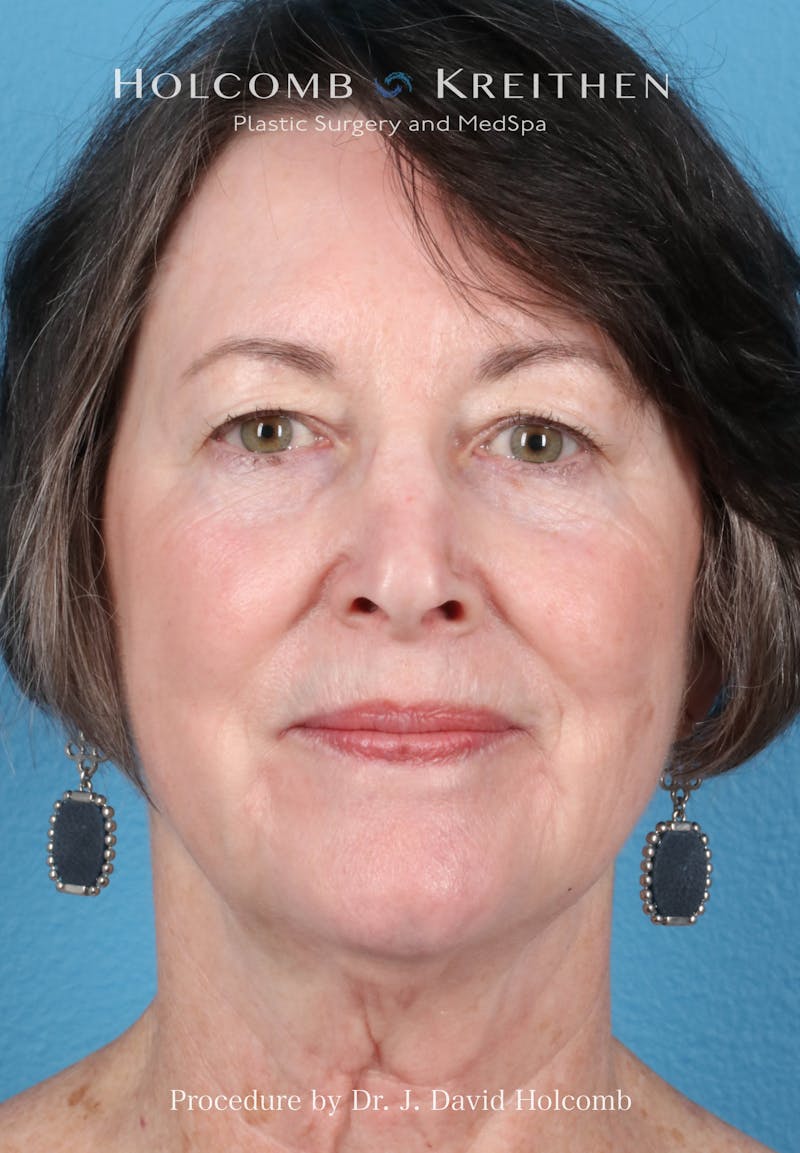 Facelift Before & After Gallery - Patient 188566 - Image 1