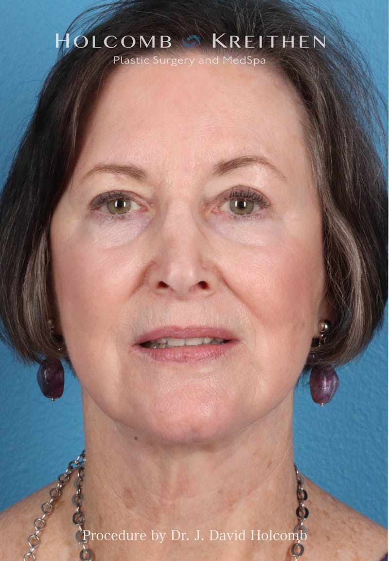 Facelift Before & After Gallery - Patient 188566 - Image 2