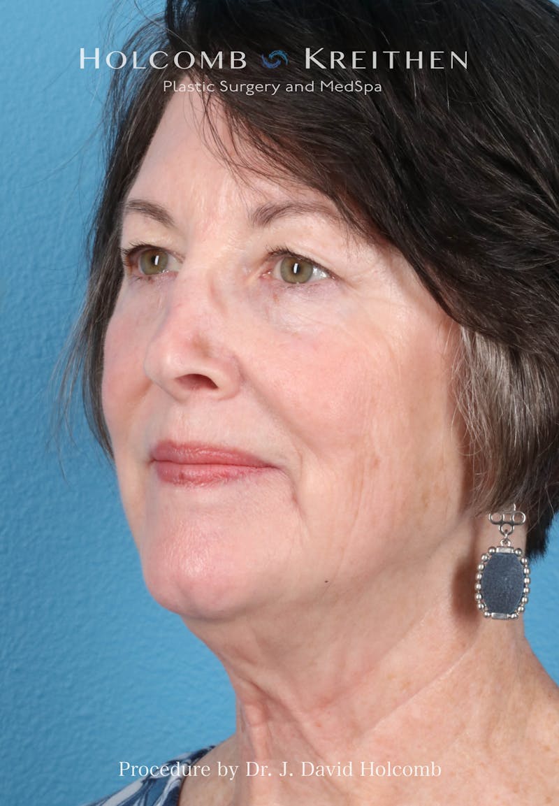 Facelift Before & After Gallery - Patient 188566 - Image 3