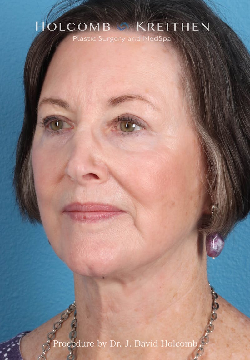 Facelift Before & After Gallery - Patient 188566 - Image 4